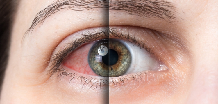 SÃ­ndrome del ojo seco: Descubre los sÃ­ntomas de esta enfermedad